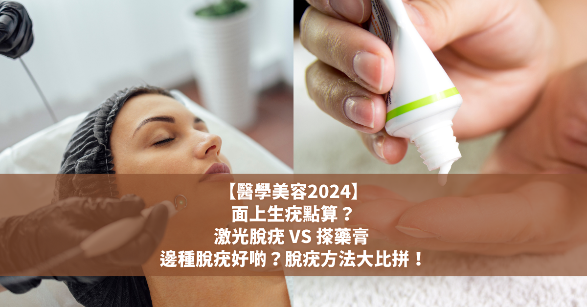 【醫學美容2024】面上生疣點算？激光脫疣 VS 搽藥膏 邊種脫疣好啲？脫疣方法大比拼！ (3)